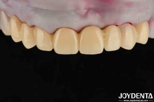 Wholesale High Transparency PMMA Dental Material Natural Color Lifelike Aesthetics from china suppliers