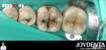 Natural Color Accurate Fit Dental Inlay For Damaged Teeth Restoration