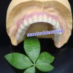 Screw Retained Dental Implant Metal Ceramic Crowns Malo Bridge