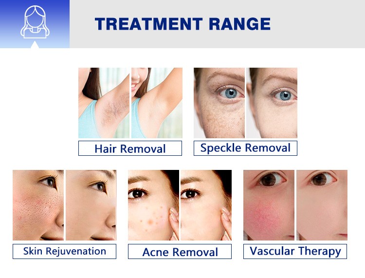 IPL OPT Beauty Machine