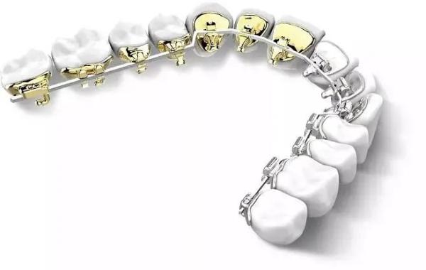 Dental BracesFixed Orthodontic Appliances Side Back Invisible Lingual Braces