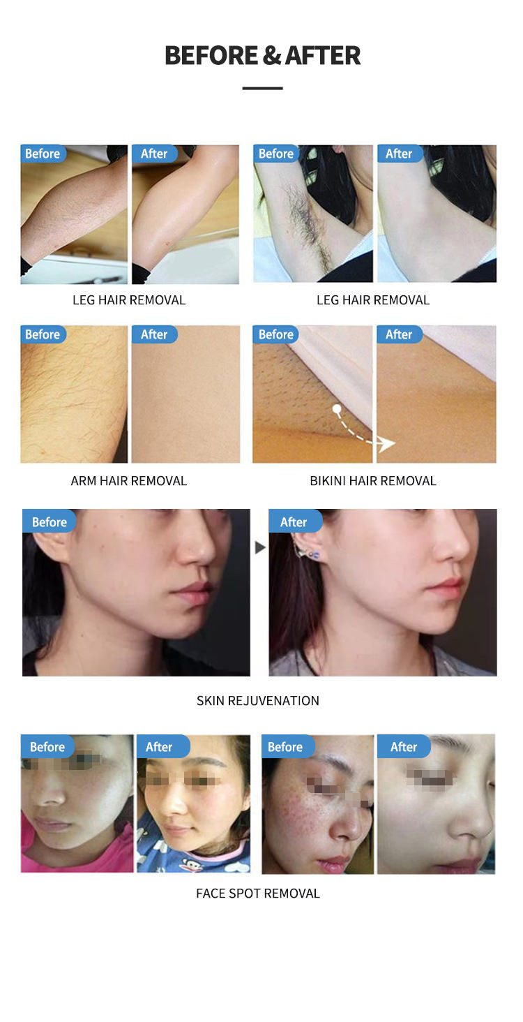 640nm-950nm OPT SHR Elight Hair Removal Machine For Skin Tightening