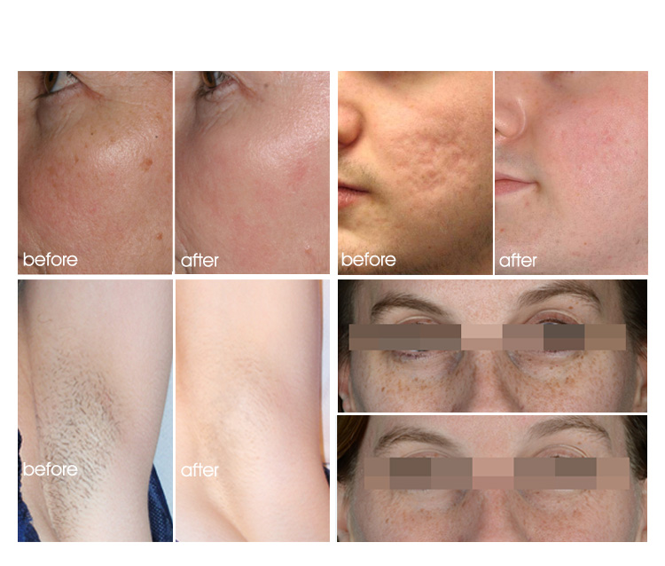 Vertical IPL Skin Rejuvenation Machine Elight Hair Removal Machine