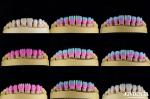 Ceramic For Natural Aesthetics Dental Veneers Stain Resistance Maintains
