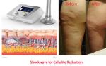 Acoustic shockwave therapy pain relief electromagnetic wave shock wave therapy