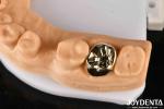 Metallic Material Dental Gold Crown , Gold Tooth Crown For Optimal Oral