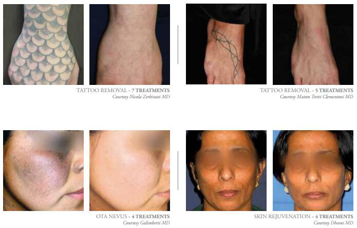 nd yag tattoo removal effect