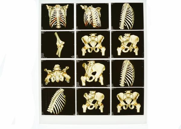 Blue X Ray Diagnostic Imaging , Medical Laser Paper Xray Photographic Film