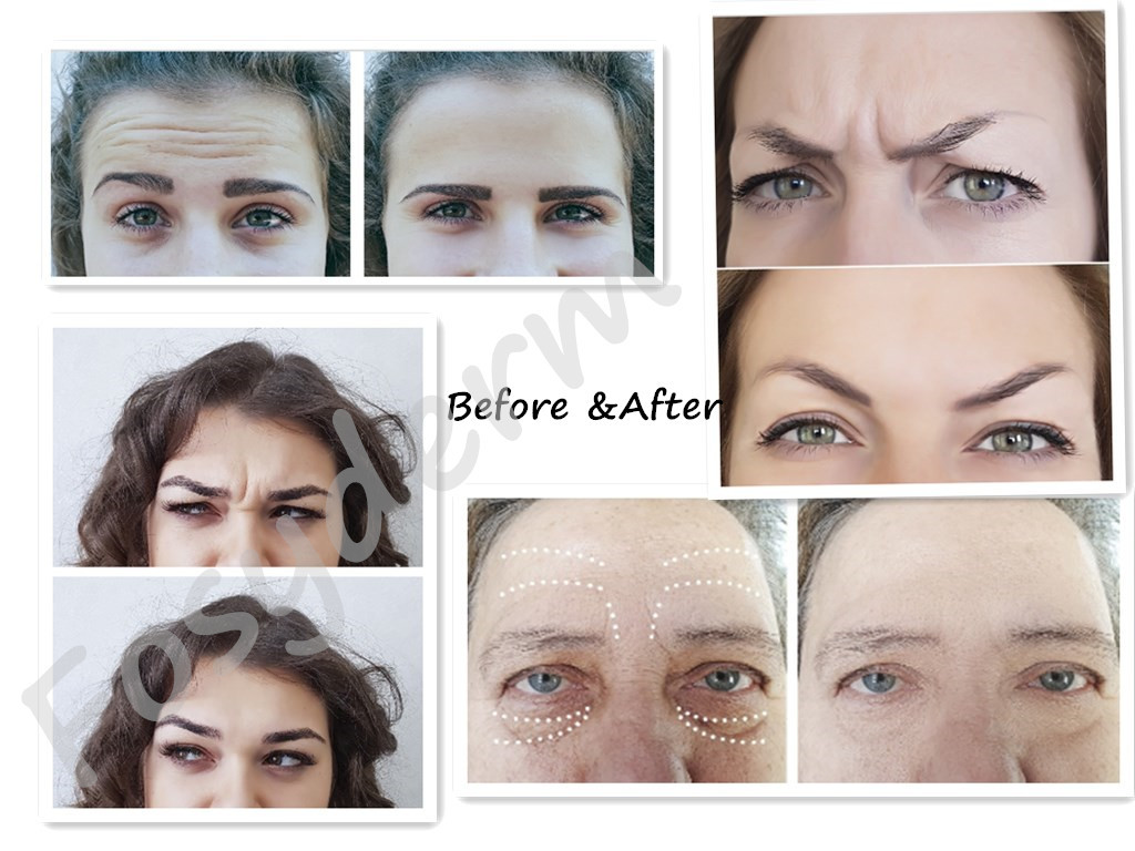 Facial Hyaluronic Acid Dermal Filler With Syringe For Lip Nose Chin Cheek 24mg