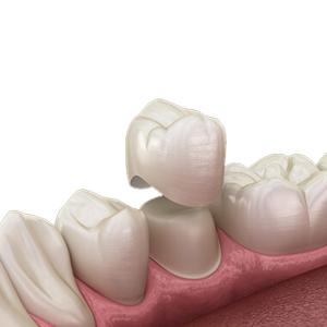 Wholesale OEM Natural Zirconia Dental Crown Unique Crack Resistant Tough Curing from china suppliers