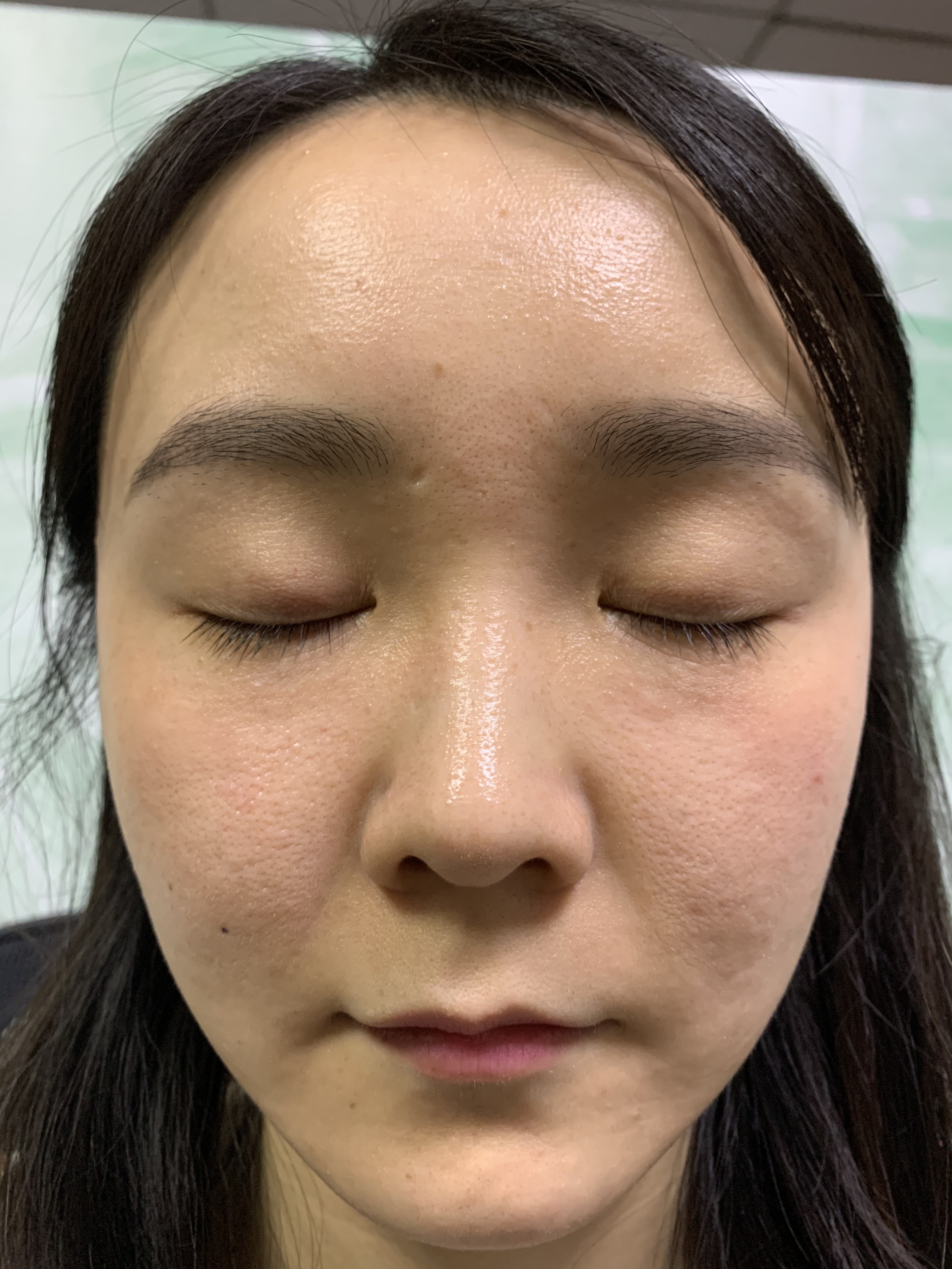 Acne Treatment RF Microneedling Machine Skin Tighting 0.2mm-2mm depth