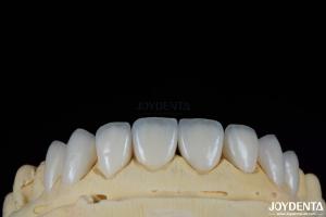 Wholesale Glossy Surface Texture Feldspathic Veneer Natural Looking Porcelain Veneer from china suppliers
