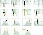 Orthodontic Burs Mani Dental Burs CRK Stainless Steel Dental Diamond Burs