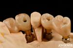 Restoration Of Missing Teeth Implant Crown and Bridge Safe For Oral with