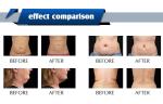 40 Khz Vacuum Ultrasound Cavitation System RF Therapy Body Detox Sculpting Fat