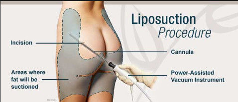 High Vaccum Surgical Buttocks Liposuction Machine Power Assisted For Hospital