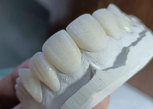 Wholesale Strength Wear Resistant Ceramic crown Bridge for Comfortable Precise Dental Restoration from china suppliers