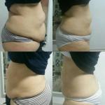 60HZ Professional Cellulite Treatment Machine Anti Cellulite Massager Double