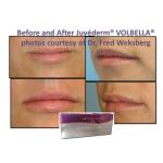 Hyaluronic Acid Juvederm Facial Filler Gel Smooth And Flawless Skin