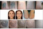 755nm 1064nm Picosecond Tattoo Removal Machine 500ps Nd Yag Laser