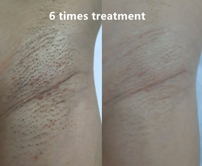 Portable 810nm Trio Depilation Diode IPL Laser Beauty Machine 3 Wavelengths