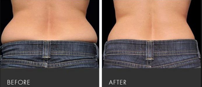 Liposonix Fat Reduction Hifu High Intensity Focused Ultrasound Machine For Body Contouring
