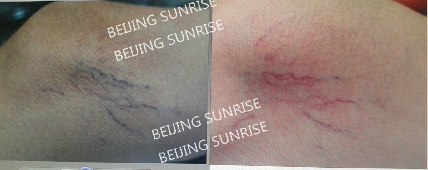 15W/30W spider vein removal 980 diode vascular laser machine diode laser 980nm