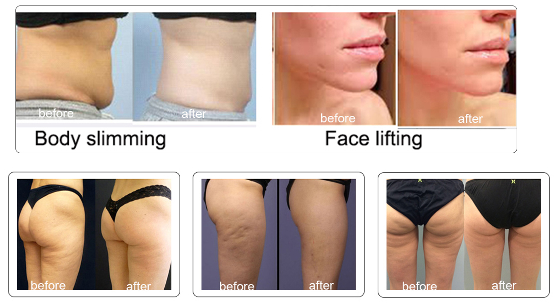 Ice Ret Cet Rf Skin Tightening Face Lift Machine Stationary