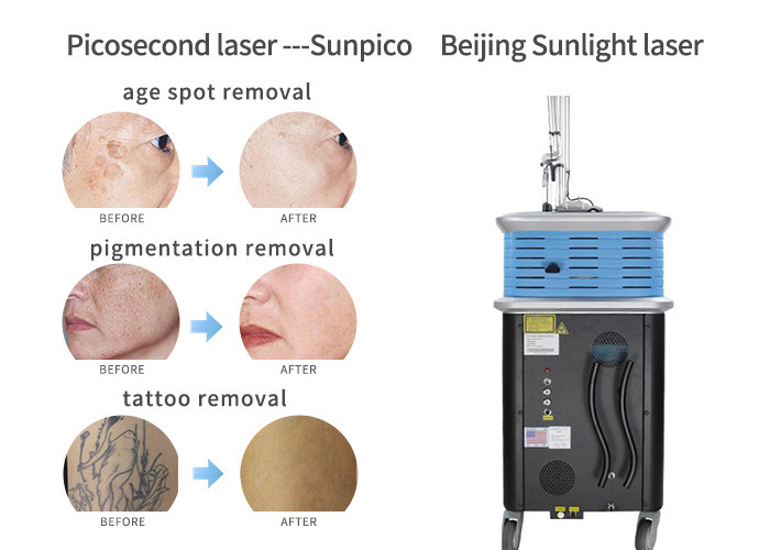 Painless Picosecond Laser Tattoo Removal Machine 755m Two Years Warranty