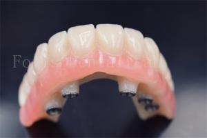 Wholesale Customized Dental Implants Crowns Replacement Wear Resistance from china suppliers