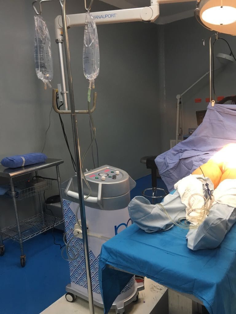 Anaesthetic Infusion System Surgical Liposuction Machine Weight Loss