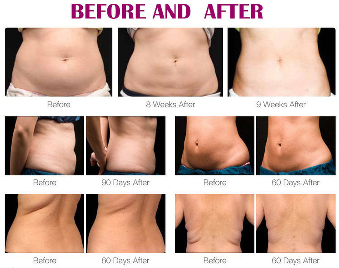 Lipo Cryo Kim 8 80k Ultrasonic Cavitation Machine Body Sculpt 5 Handles