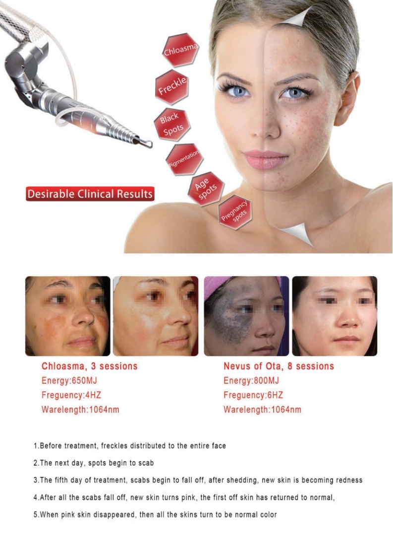 Nd Yag Laser Tattoo Removal Machine