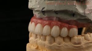 Wholesale Hybrid Titanium Screw Retained Dental Implant Crown All On 4 Dental Implant Zirconia Bridge from china suppliers