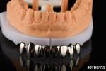 Dental Abrasive Resistant Crown Full Metal , Metallic FMC For Oral Rehabilitatio