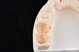 Wholesale Natural Looking Dental Zirconia Inlays And Onlays High Esthetically Precise Fit from china suppliers