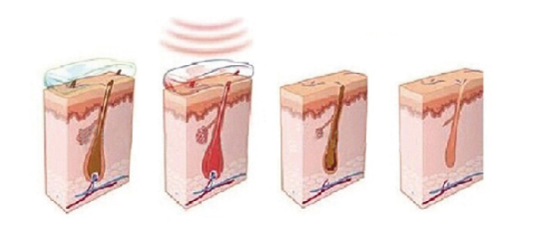 3000W strong power ipl shr hair removal machine best permanent hair removal system