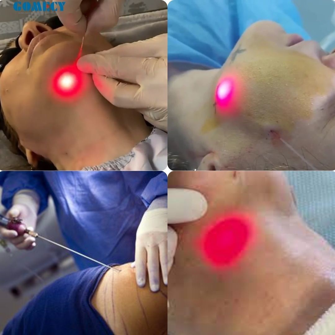 15W/20W 1470nm Endolaser for Liftinging Facial Lipolysis and Endovenous Laser Spider Vein Removal 3 Meters Fiber