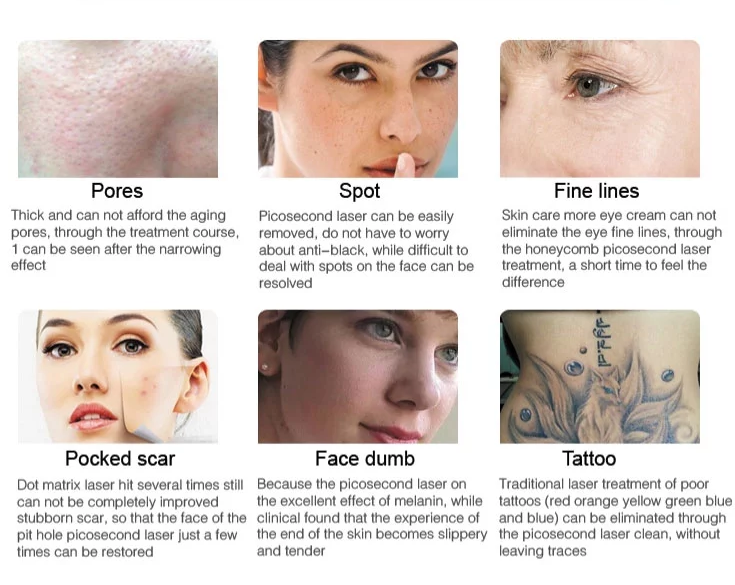 Portable Pico Second Laser Tatoo Remover Q Switch Nd Yag Picosecond Tattoo Removal Machine
