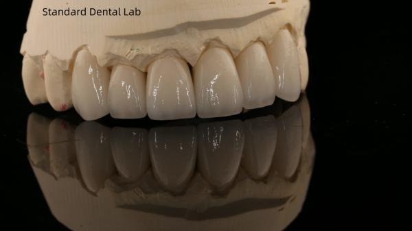 Full Contour Zirconia Crown and High Aesthetic Natural Dental Bridge 5 Year