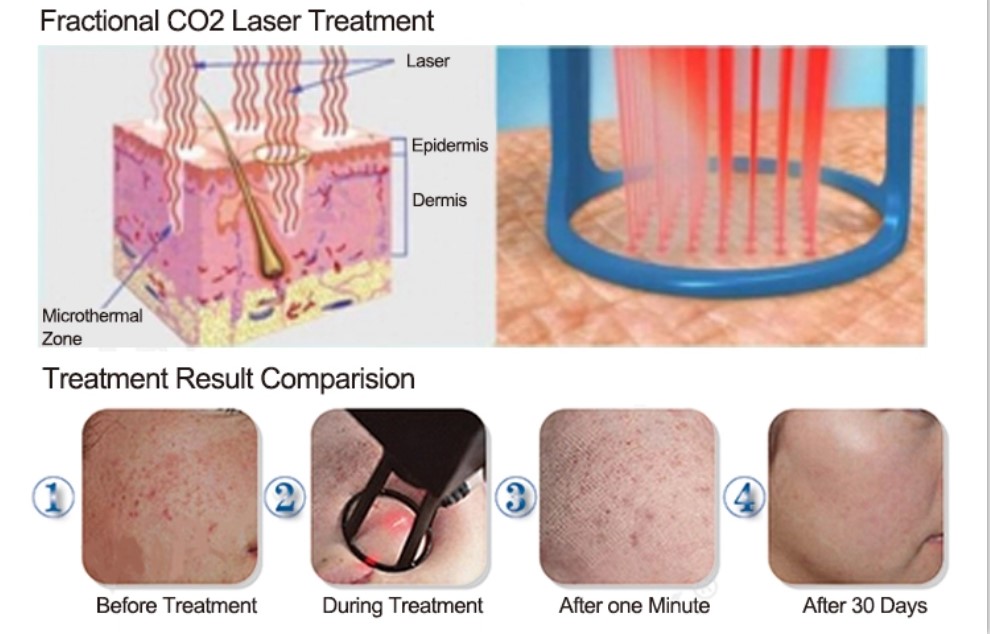 Carbon Dioxide Laser Fractional CO2 Machine For Skin Brightening And Tightening