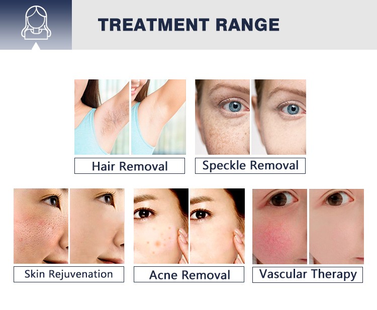 IPL Laser Single Pulse Technology Hair Removal Device Elight+IPL Skin Rejuvenation Machine