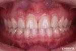 Real Looking Dental Porcelain Veneers Perfectly Fit Ceramic Teeth Veneers For