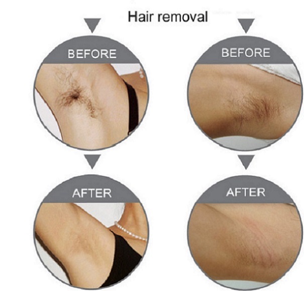 Laser hair removal machine 808nm Diode Laser Hair Removal Equipment For Women or Men