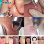 1470nm 980nm Diode Laser Veins Removal Machine Vascular Surgery Instruments