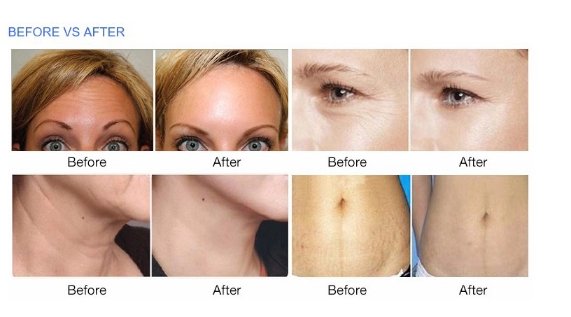 Rf Eye Skin Lifting Tightening Best Radio Frequency Machine rf skin tightening machine