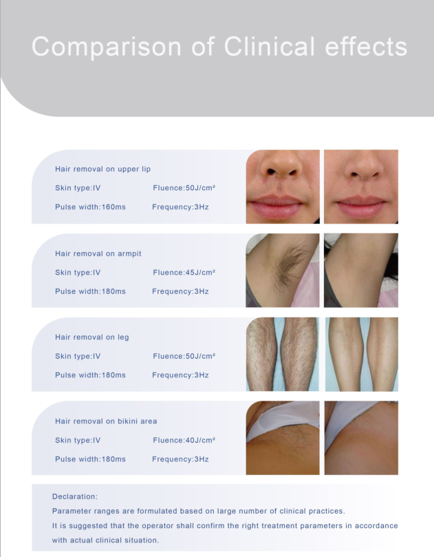 Germany Diode Medical CE All Skin Types Fast Hair Removal 808nm diode laser 10Hz