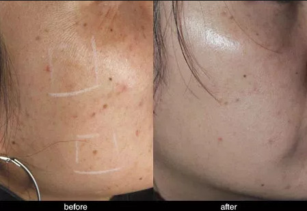 Mole Removal CO2 Fractional Laser Machine , CO2 Laser Machine For Acne Scars