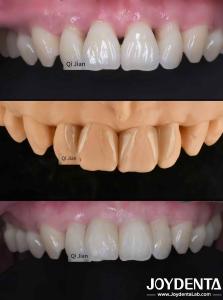 Wholesale Grassshopper Veneers The Perfect Solution For Natural Translucency Dental Veneers from china suppliers