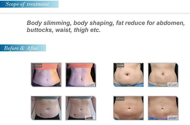 high intensity focused ultrasound slimming machine/hifu slimming for body shape ultrashape hifu machine